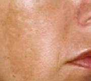 Tamsių dėmių ant odos tipai ir priežastys Kepenų funkcijos sutrikimas